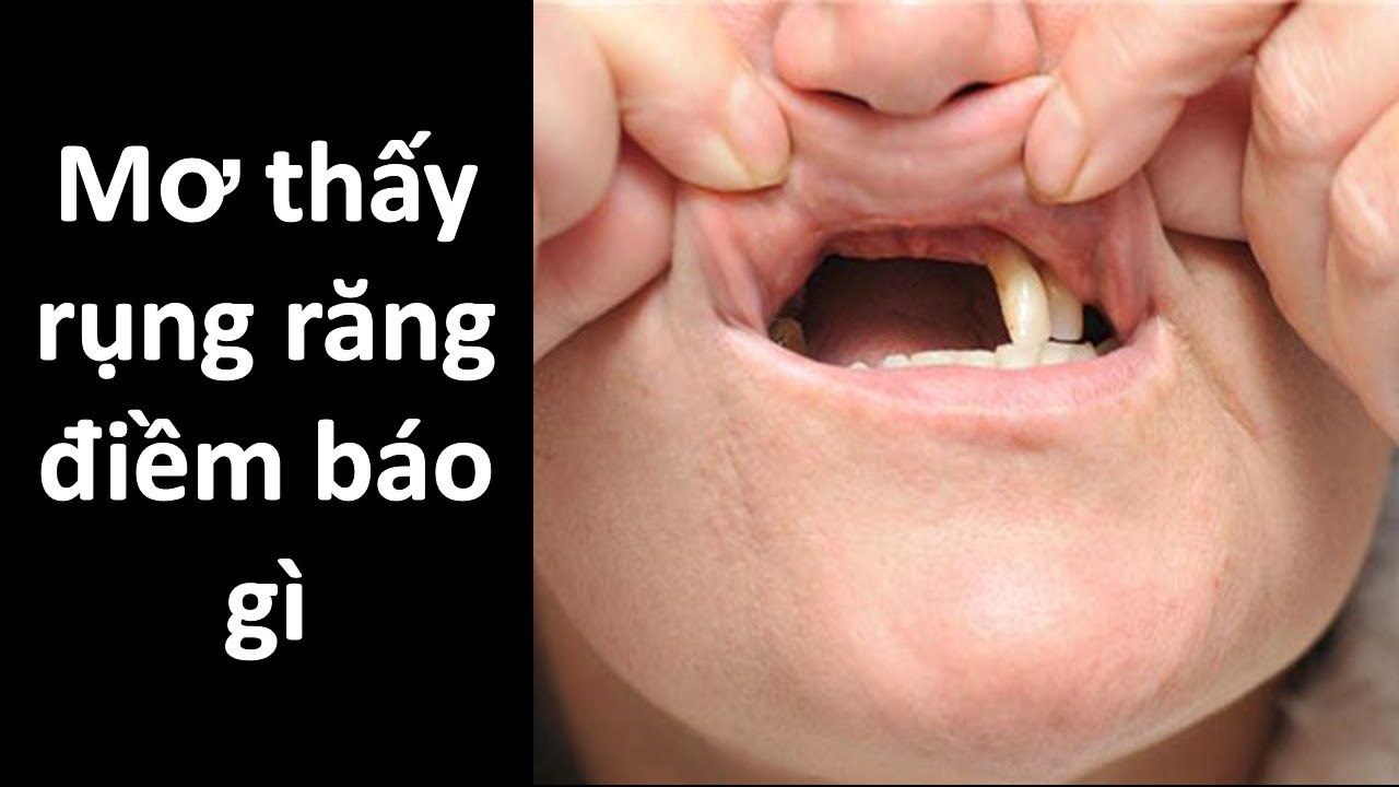 May88 VIP giải mã điềm báo khi mơ thấy rụng răng